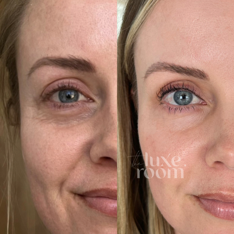 prf-gel-undereye-denver-boulder-fort-collins