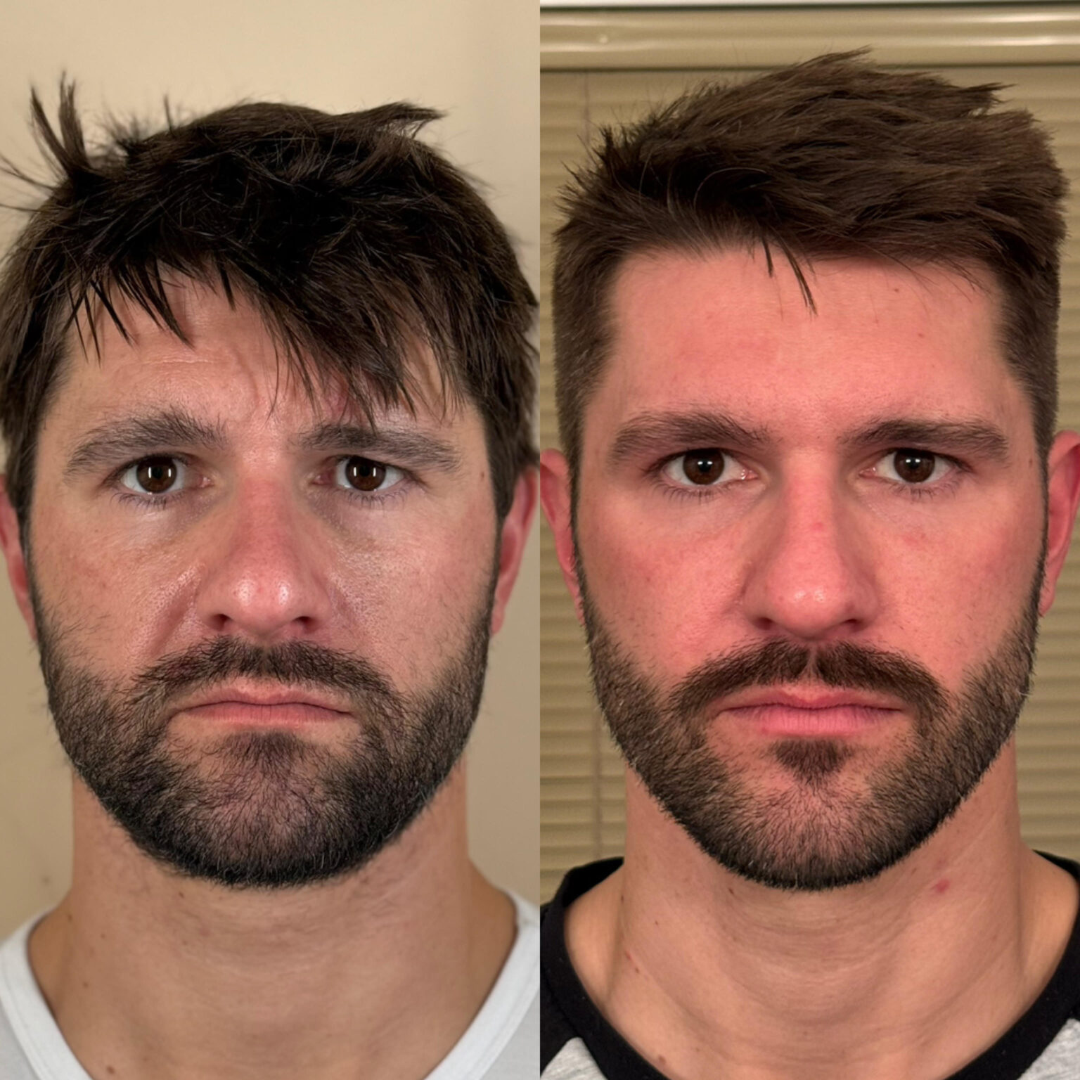 mens-botox-results-denver-colorado